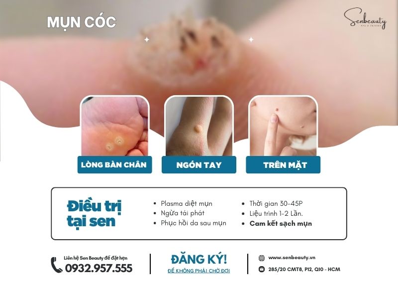 Trị các loại mụn nhọt trứng cá có cam kết